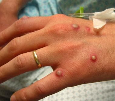 Three cases of monkeypox suspected in Morocco